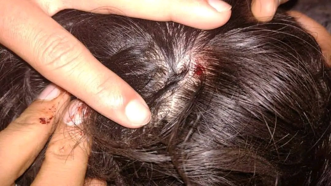 Breaking: HPU में दो छात्र गुटों के बीच खूनी झड़प 7 घायल