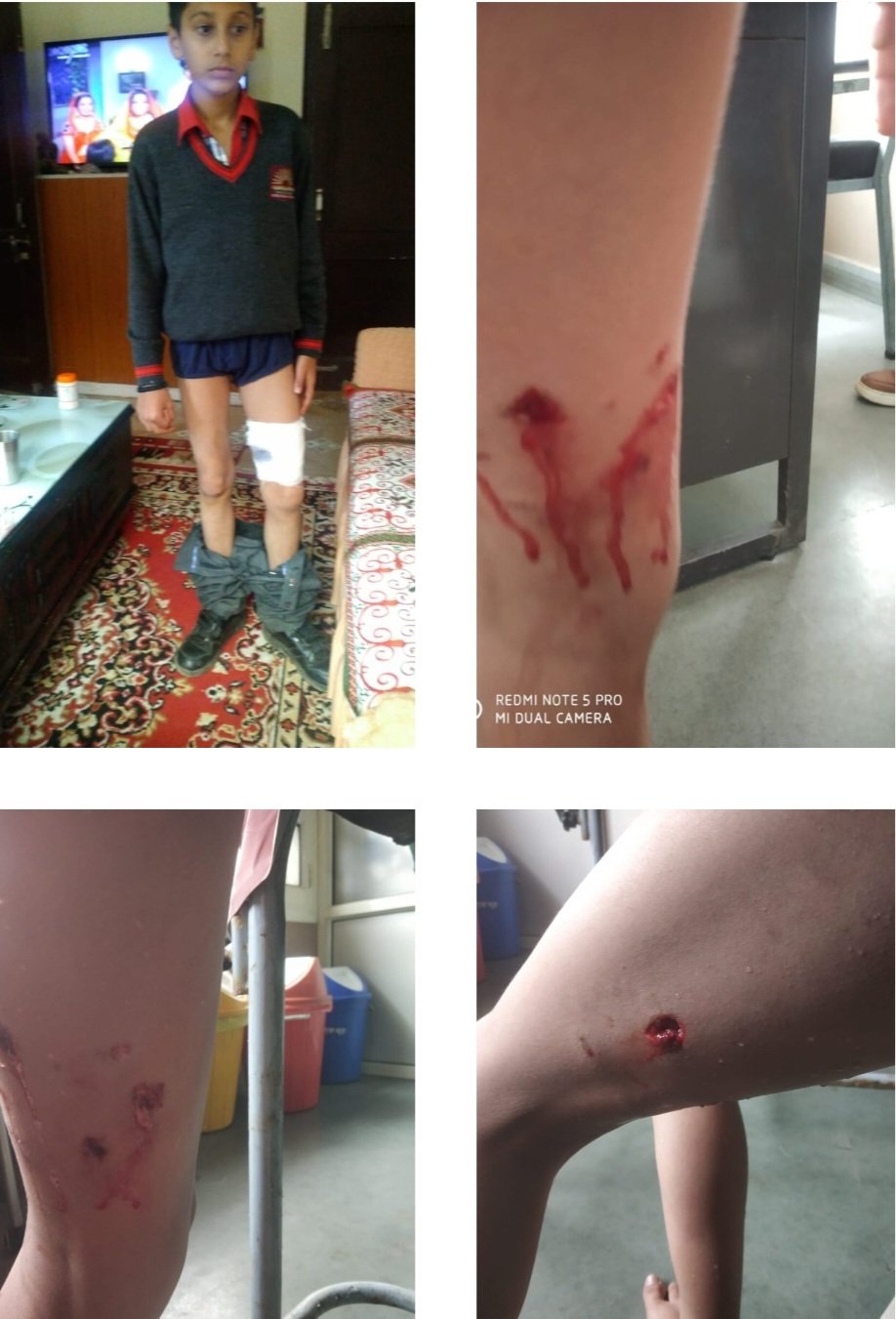 Breaking: शिमला में कुत्तों का आतंक जारी KV में पढ़ने वाले 7 वीं कक्षा के बच्चे को काटा